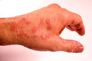 rash on hand